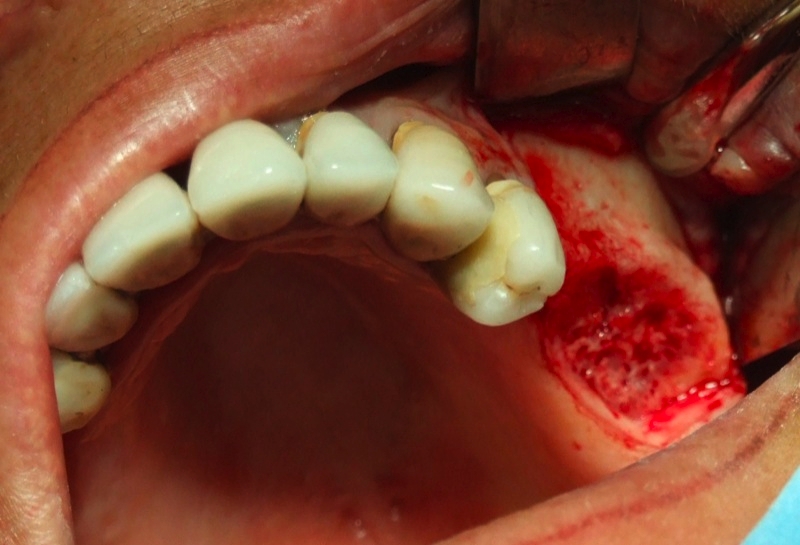 Rimozione ponte ed estrazione denti